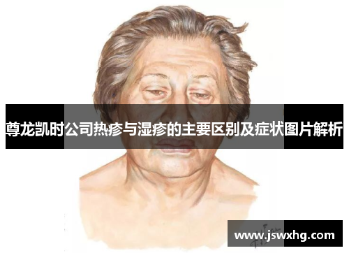 尊龙凯时公司热疹与湿疹的主要区别及症状图片解析 尊龙凯时公司热疹与湿疹的主要区别及症状图片解析
